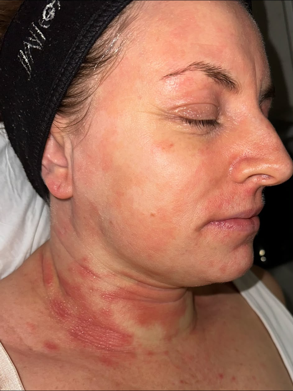 Before treatment result 3