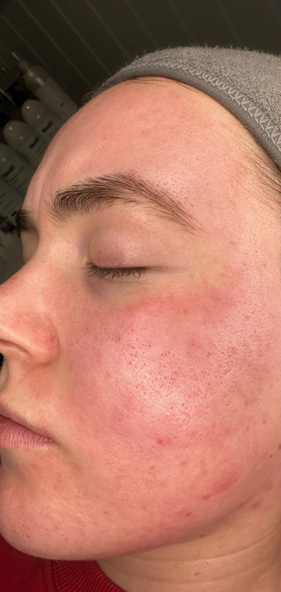 Before treatment result 4
